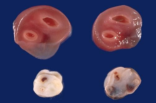 Single umbilical artery