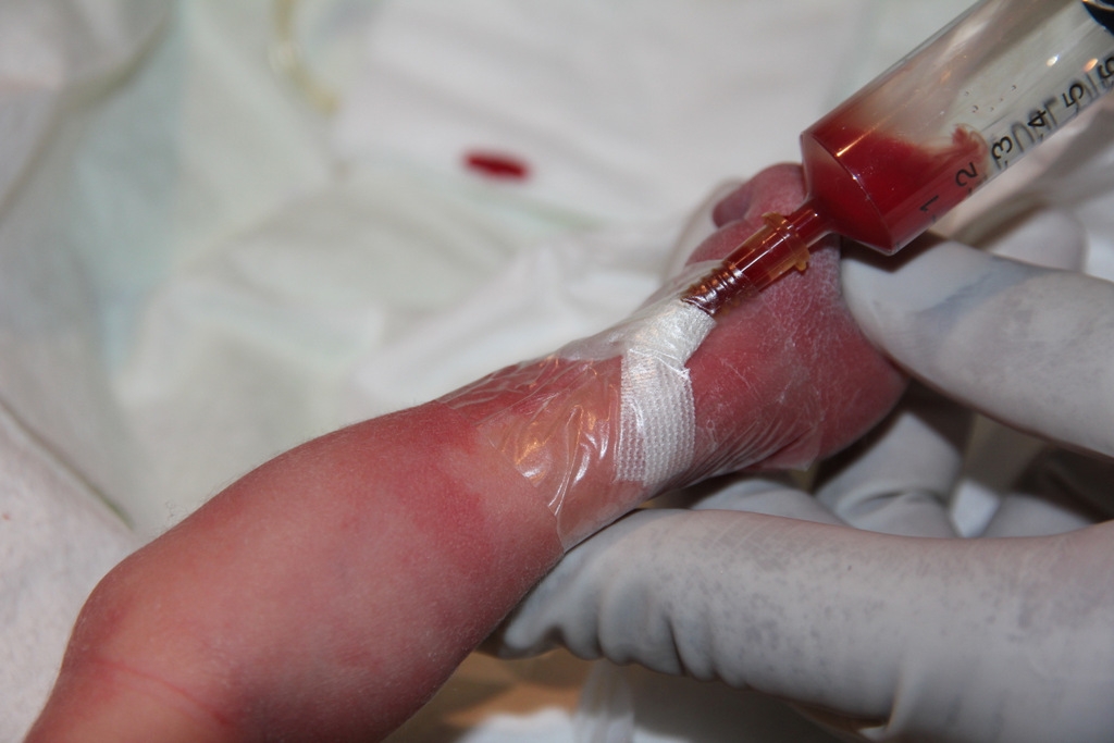 Figure 4: Blanching of the artery