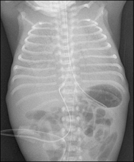 Figure 2: CXR showing 'ground glass' appearance