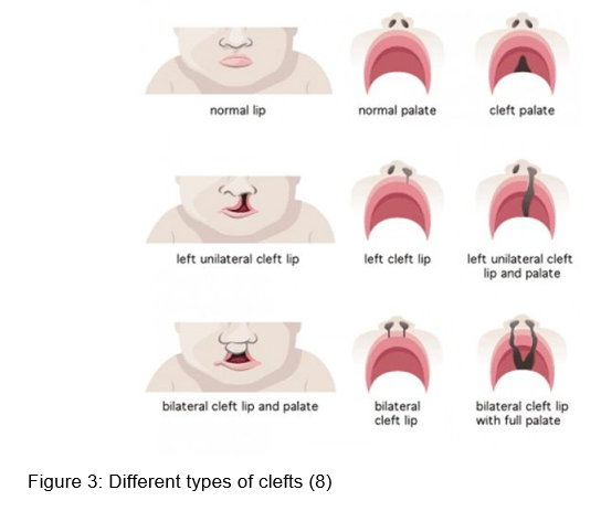 Illustration of different types of clefts
