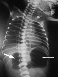 Figure 4: X-ray showing 'double bubble'