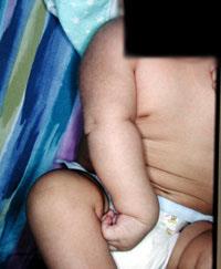 Figure 1: Erb's palsy