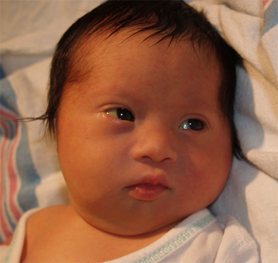 Figure 1: Facial features of Down syndrome