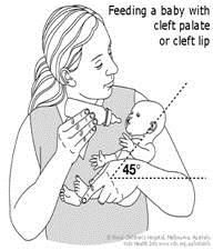 Figure 3: bottle feeding, cleft lip and palate