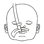 Illustration showing alternative method of securing oral ET tube