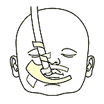 Figure 3. Step 2 - strapping the tube