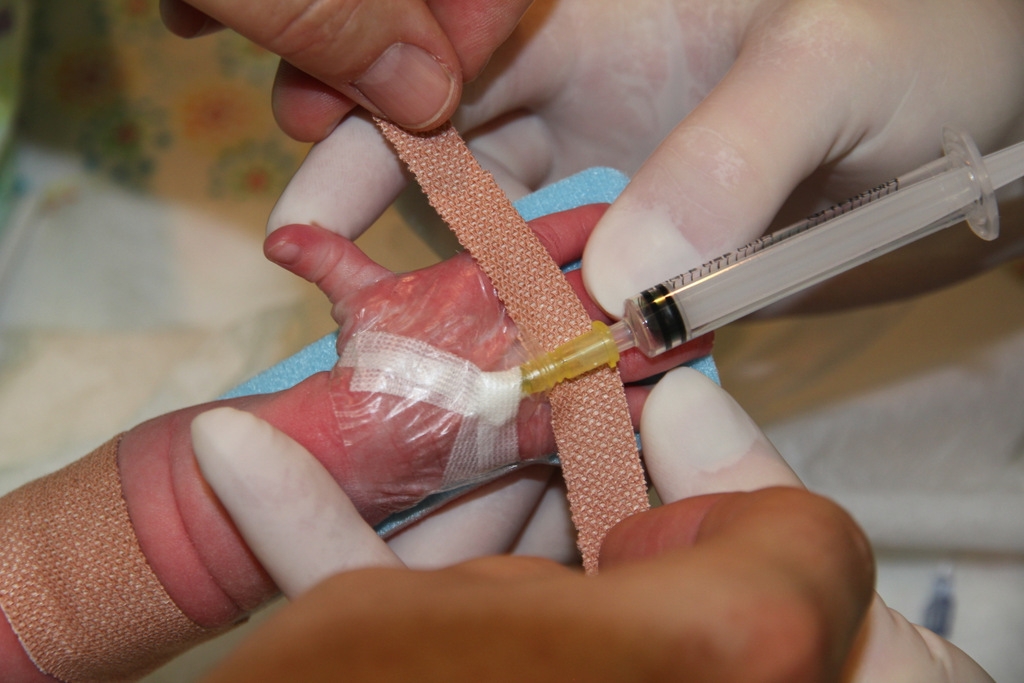 Figure 10: Attaching the splint 1