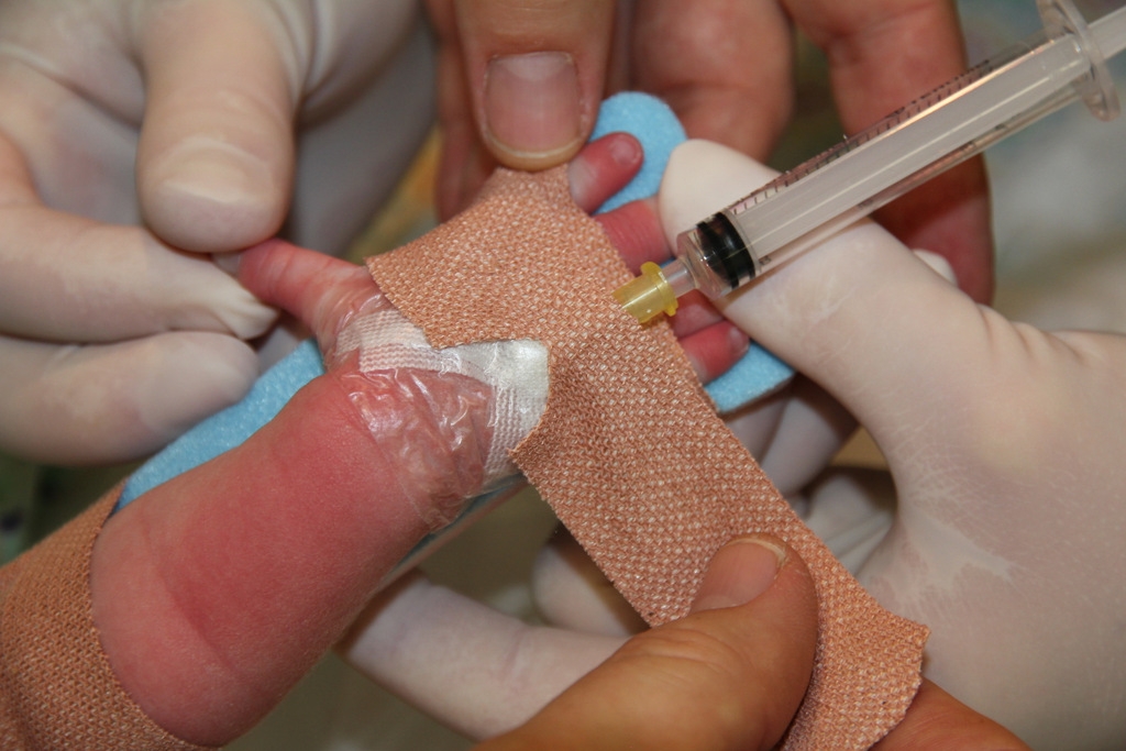 Figure 11: IV, attaching the splint 2