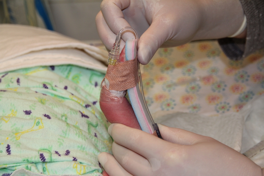 Figure 12: IV, attaching the splint 3