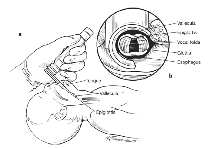 Intubation procedure for neonates