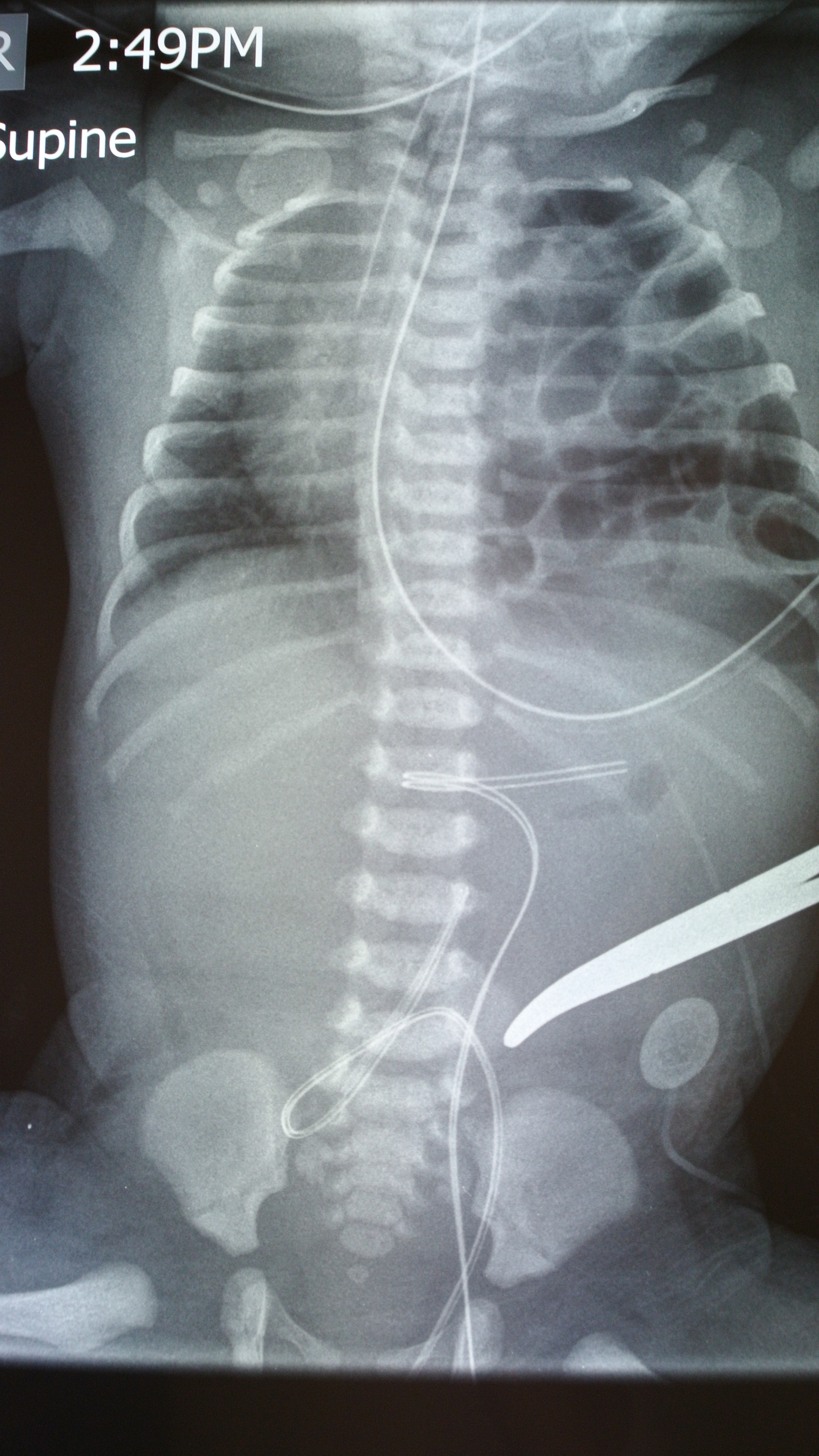 Left diaphragmatic hernia x-ray
