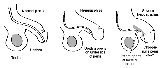 Figure 2: Lateral view of hypospadias