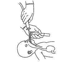 Figure 1: Aspiration of meconium under direct vision