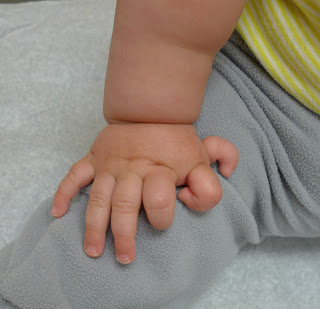 Figure 5: Polydactyly left hand