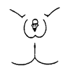 Prader 2: Clitoromegaly with partial labia fusion forming a funnel-shaped urogenital sinus