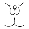 Prader 3: Increased phallic enlargement