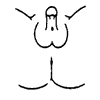 Prader 4: Complete scrotal fusion