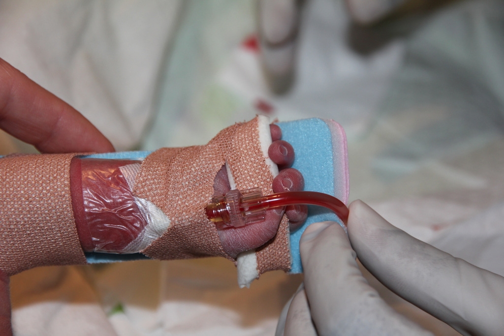 Figure 3a: Securing of peripheral arterial line