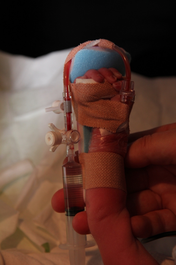 Figure 3b: Securing of peripheral arterial line