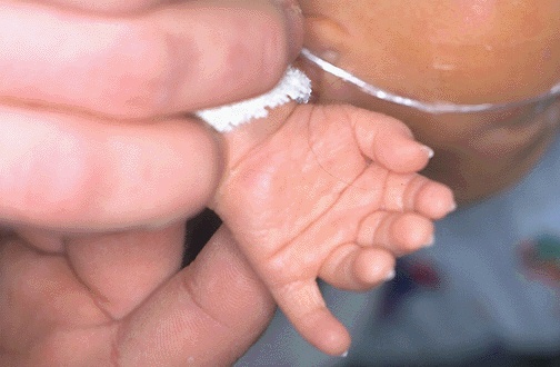 Figure 2: Simean crease in Down syndrome