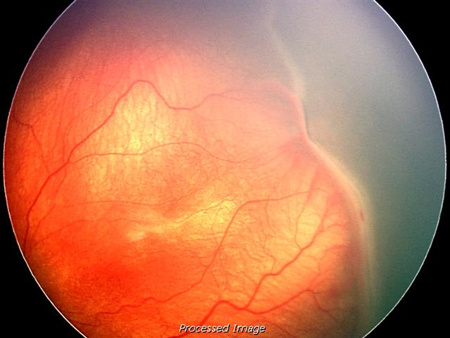 Stage 3: extraretinal fibrovascular proliferation