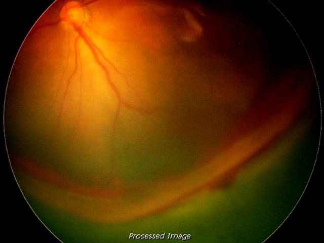 Stage 4: partial retinal detachment