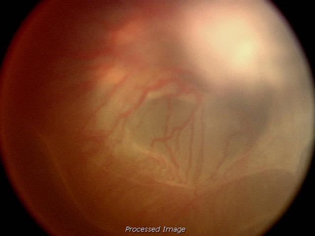 Stage 5: total retinal detachment