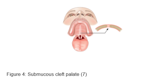 Illustration of submucous cleft palate