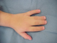 Figure 4a: Syndactyly left hand