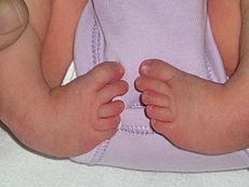 Figure 3: Talipes equinovarus, club foot