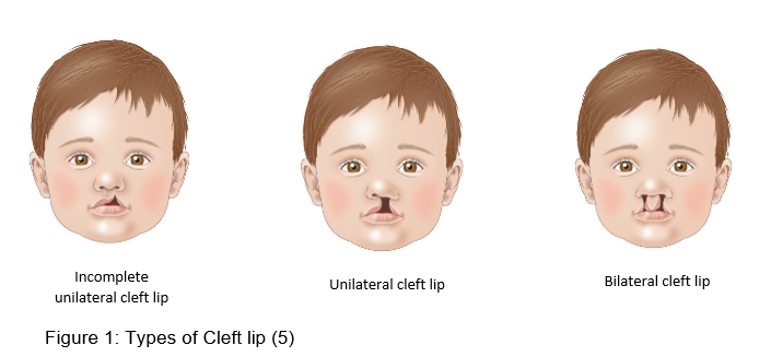 Illustrations of three types of cleft lip