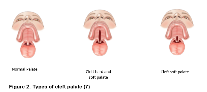 Illustrations of the three types of cleft palate