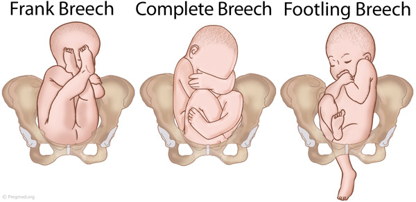 presentation vs breech