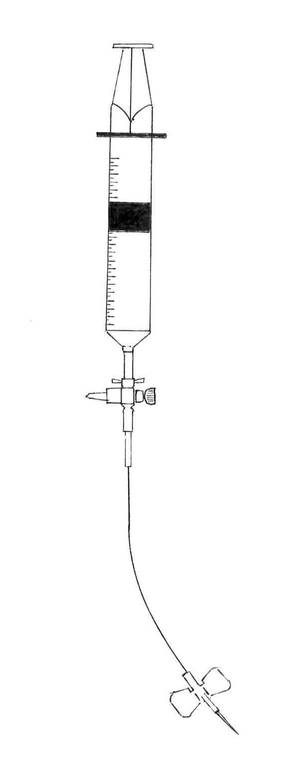 Drawing of a needle used for emergency drainage