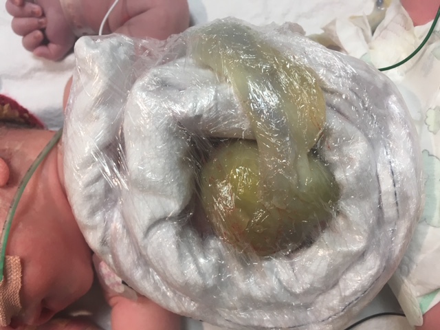 Example of an exomphalos donut
