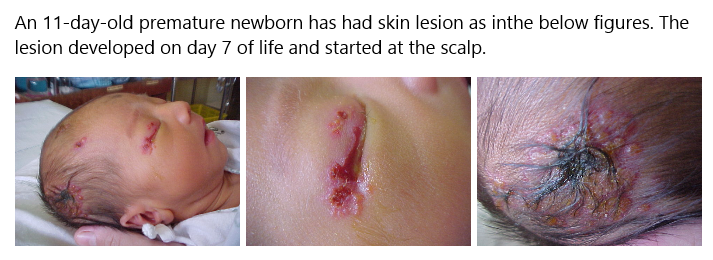 Newborn with herpes simplex virus skin lesions