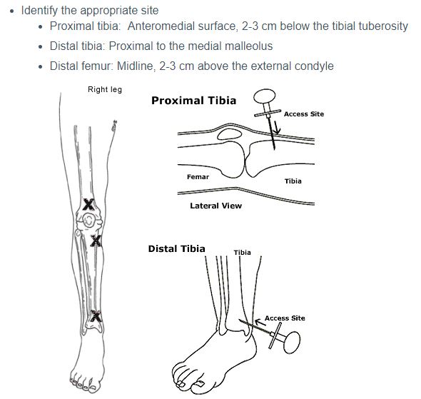 Intraosseus insertion: proximal tibia