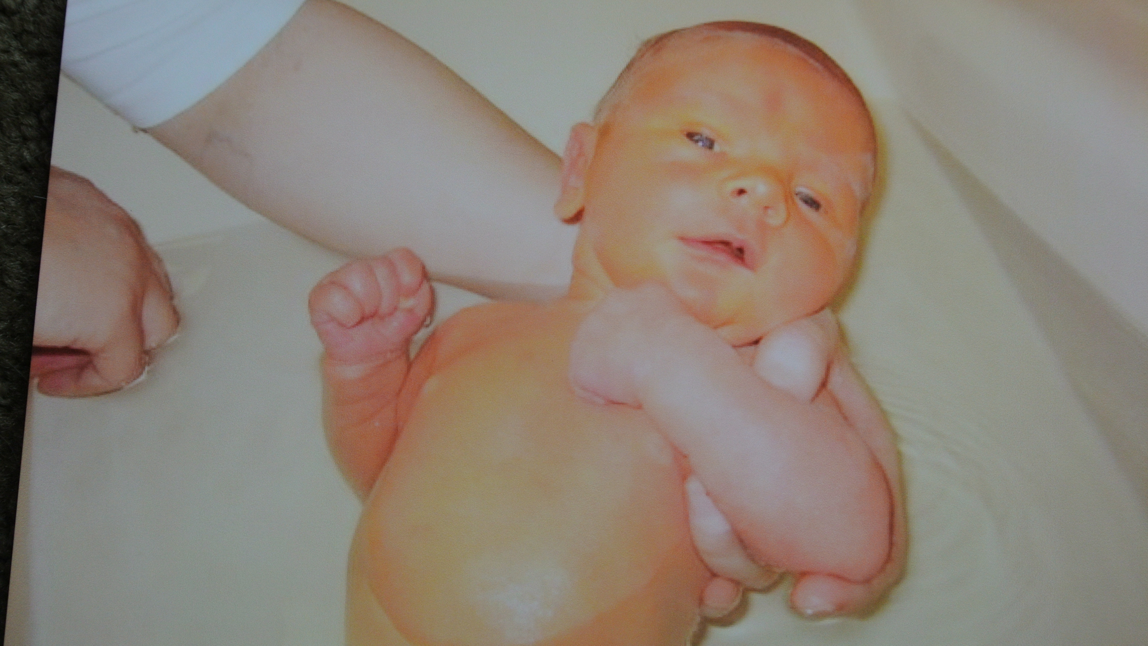 Figure 1: Jaundice in a newborn