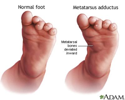 Figure 2: Metatarsus adductus