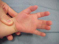 Figure 4b: Syndactyly left hand