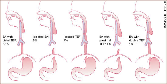 Figure 1: Oesophageal atresia