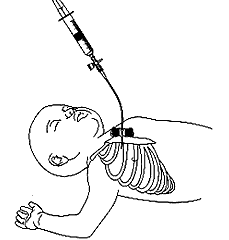 Position for needle aspiration diagram