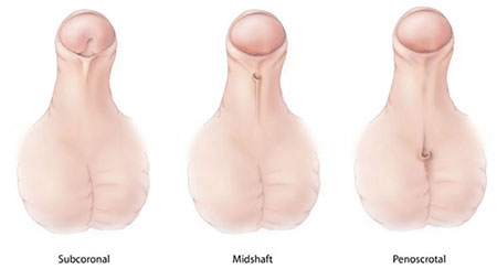 Figure 1: Types of hypospadias